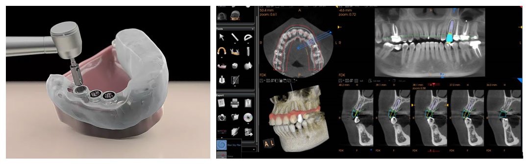 Digital implant dentistry 